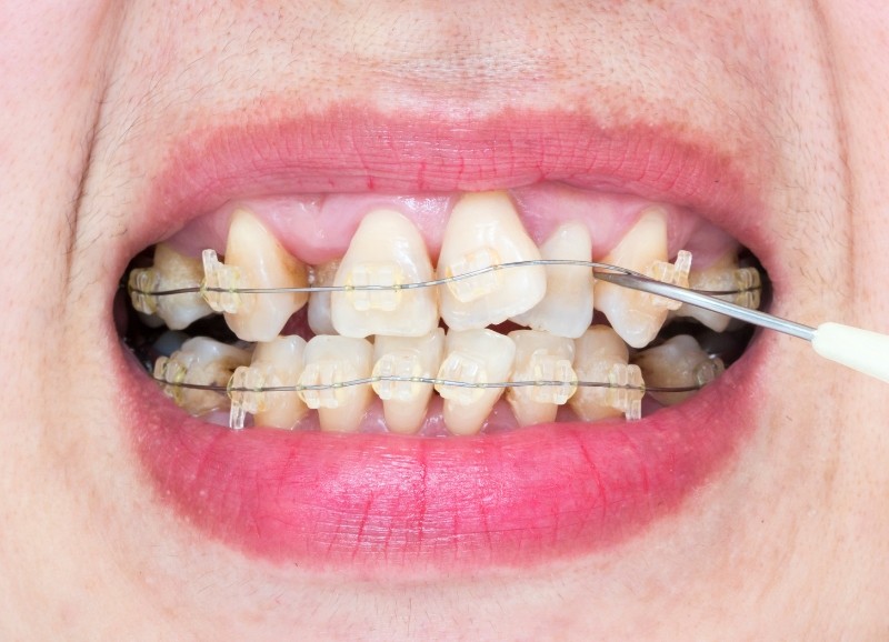 Cần chú ý các vấn đề sức khỏe răng miệng sau niềng để đạt hiệu quả tốt nhất