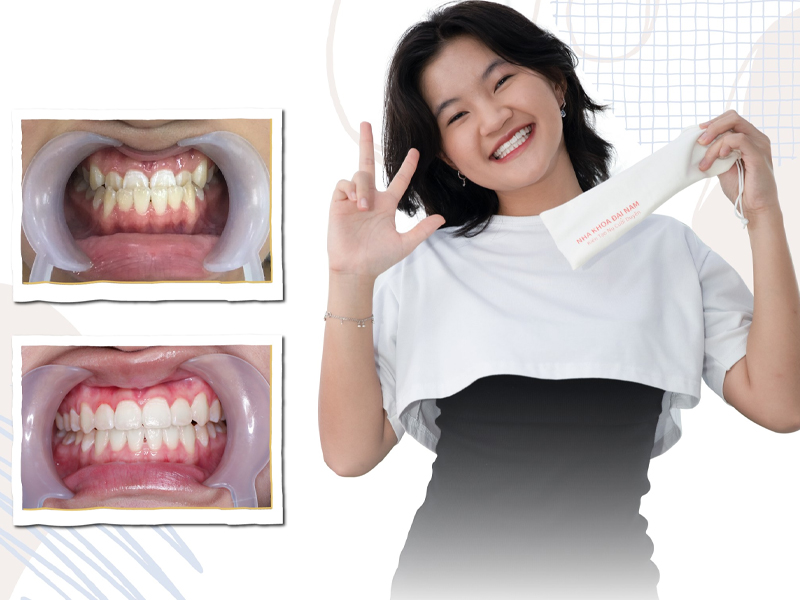 Trường hợp niềng răng thành công tại Nha khoa Đại Nam - Đà Nẵng
