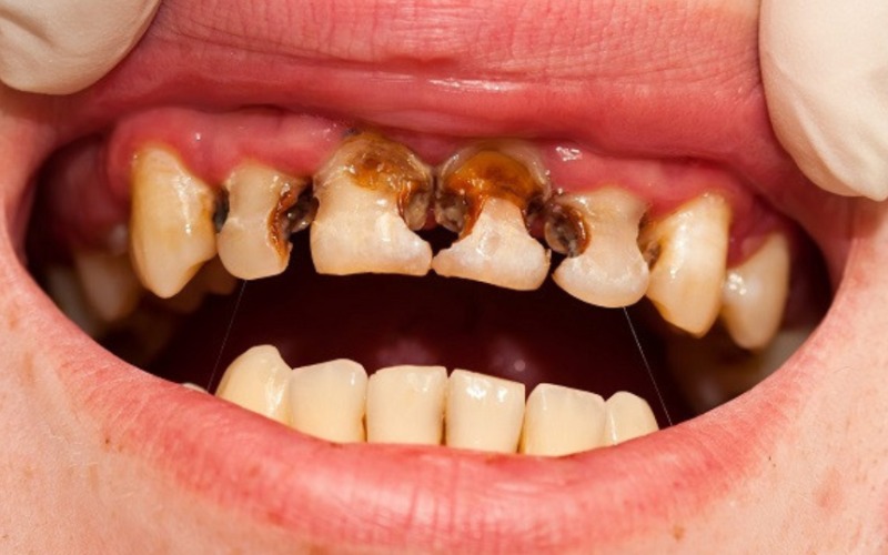 Sâu răng nặng - Tác hại nghiêm trọng của niềng răng sai cách 