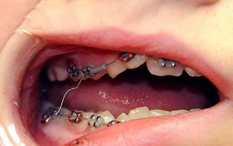 Tác hại của niềng răng - Mắc cài đâm vào môi hoặc má