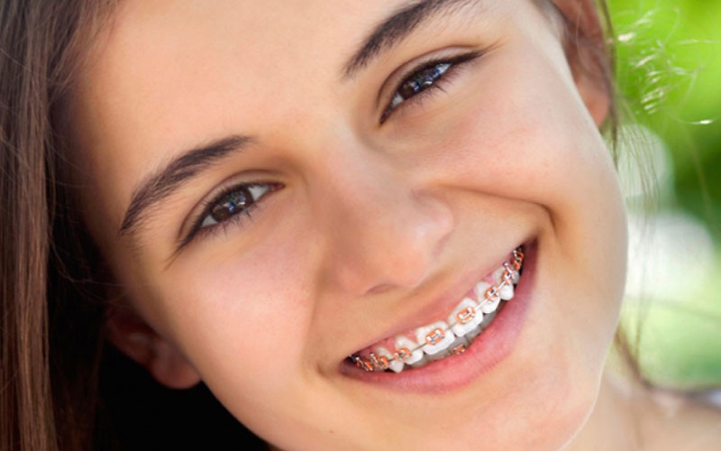 Tận dụng thời gian vàng để niềng răng, tránh những tác hại xấu