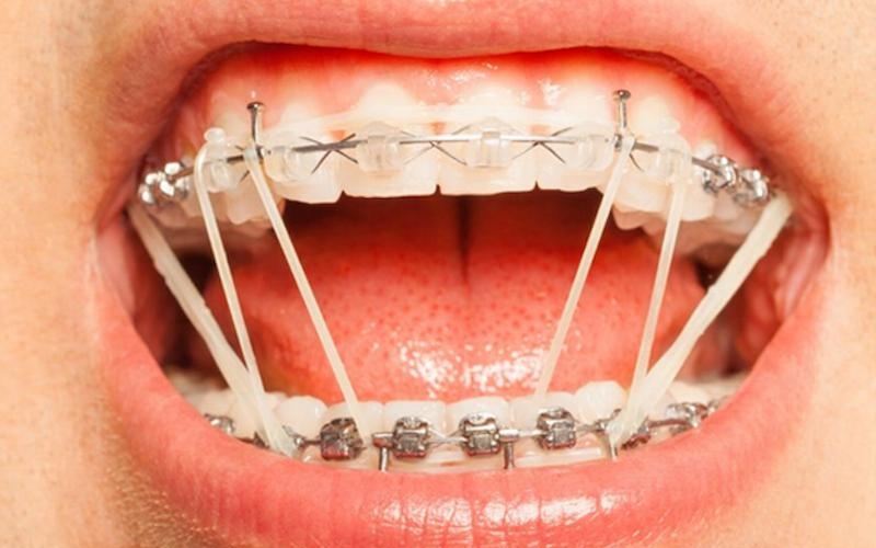 Thun niềng răng giữ vai trò quan trọng trong quá trình chỉnh nha 