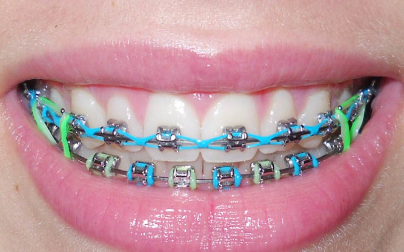 Thun chuỗi có tác dụng lấy đầy khoảng trống giữa các răng trên cùng một cung hàm 
