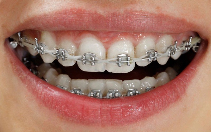 Thời gian đeo thun niềng răng bao lâu phụ thuộc vào mức độ lệch lạc của răng
