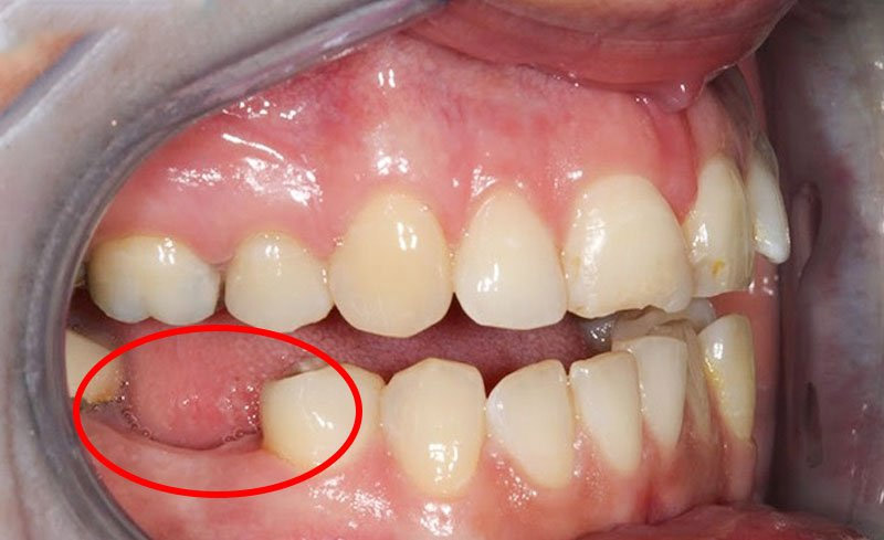 Mất răng hàm không phục hình lại sẽ gây ra nhiều ảnh hưởng