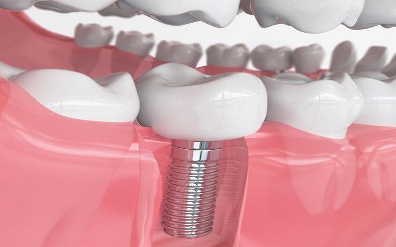 Trồng răng Implant có chi phí khá cao