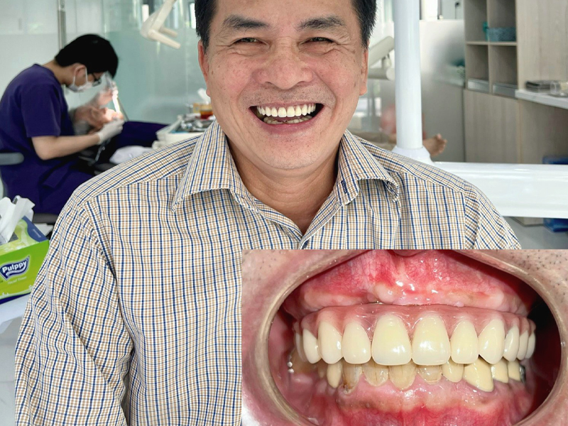 Nha khoa Việt Anh là địa chỉ trồng răng Implant Đà Nẵng chất lượng cao