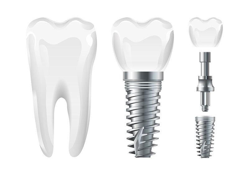 Trồng răng Implant là quá trình cấy ghép trụ Titanium gắn chặt vào xương hàm