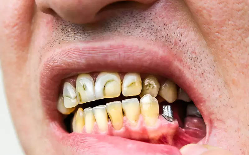 Trồng răng Implant giá rẻ có thể khiến trụ Titanium dễ đào thải