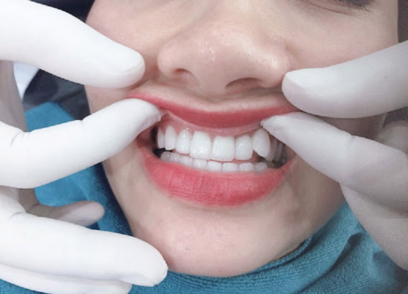 Trồng răng khểnh giá bao nhiêu phụ thuộc vào phương pháp thực hiện