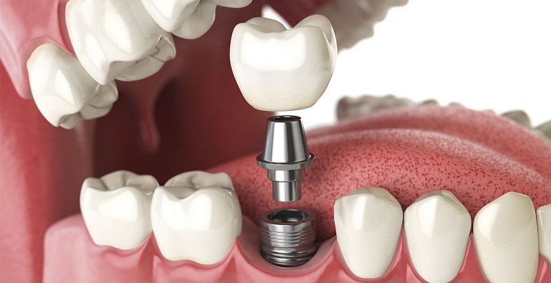 Khách hàng có thể bị đau khi cắm trụ Implant vào xương hàm