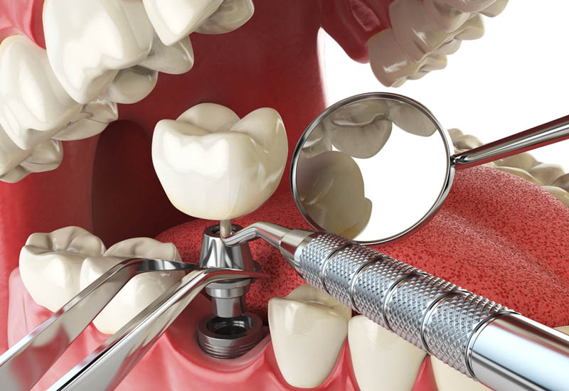Trồng răng số 6 bằng Implant có giá cao nhất