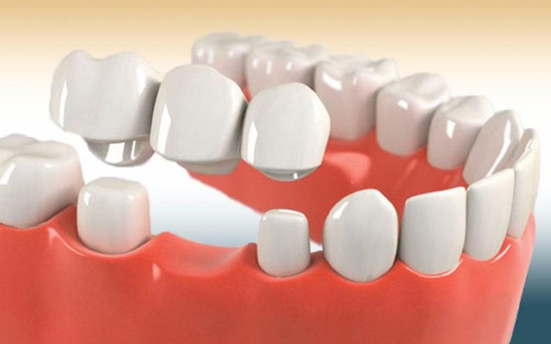 Có thể phục hình răng hàm bằng phương pháp hàm giả tháo lắp