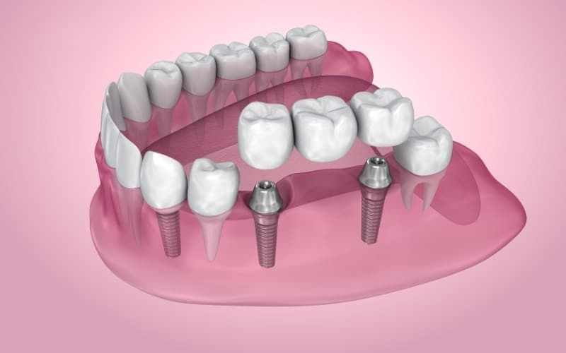 Trồng răng số 6 bằng trụ Implant là tốt nhất