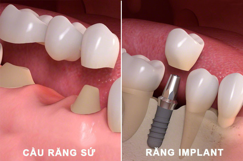 Bắc cầu răng sứ và trồng răng Implant có sự khác nhau về giá