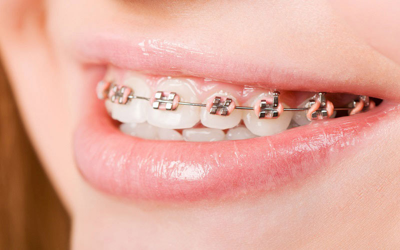 Niềng răng hay chỉnh nha là phương pháp điều chỉnh sai lệch khớp cắn