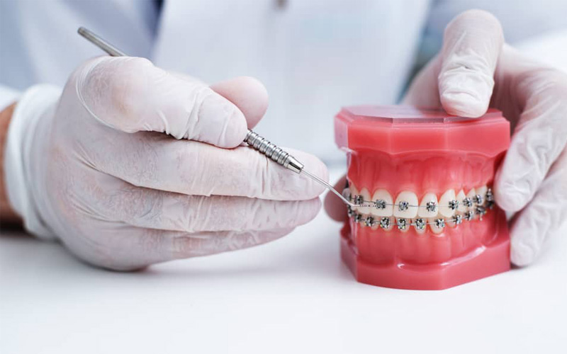 Mắc cài niềng răng là khí cụ không thể thiếu trong các phương pháp chỉnh nha mắc cài