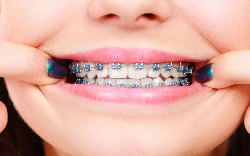 Sử dụng mắc cài niềng răng cần thời gian từ 1 - 3 năm