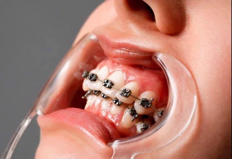 Thời gian niềng răng thường kéo dài từ 1 - 3 năm