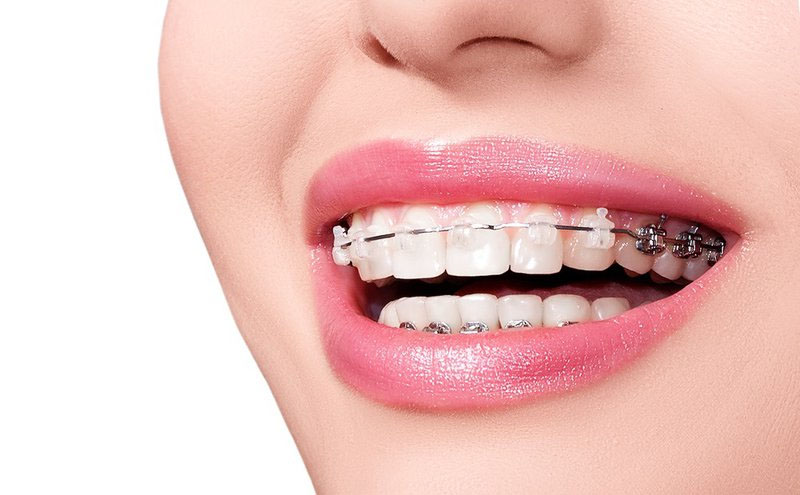Niềng răng bao lâu phụ thuộc vào tình trạng sức khỏe răng miệng của từng người