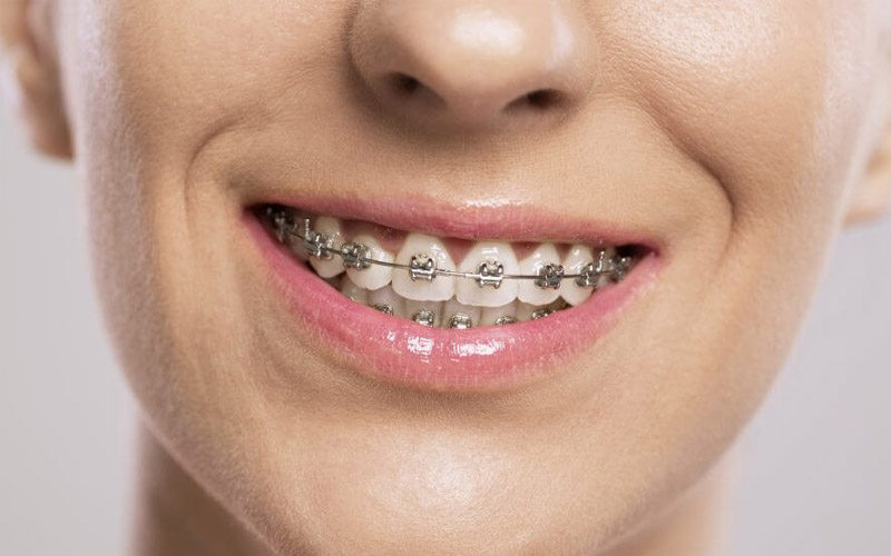 Niềng răng mắc cài kim loại vẫn được ưu tiên lựa chọn do có nhiều ưu điểm vượt trội