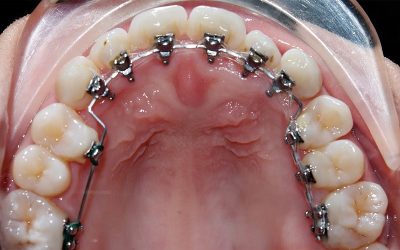 Niềng răng mắc cài mặt lưỡi gắn khí cụ ở mặt trong của răng