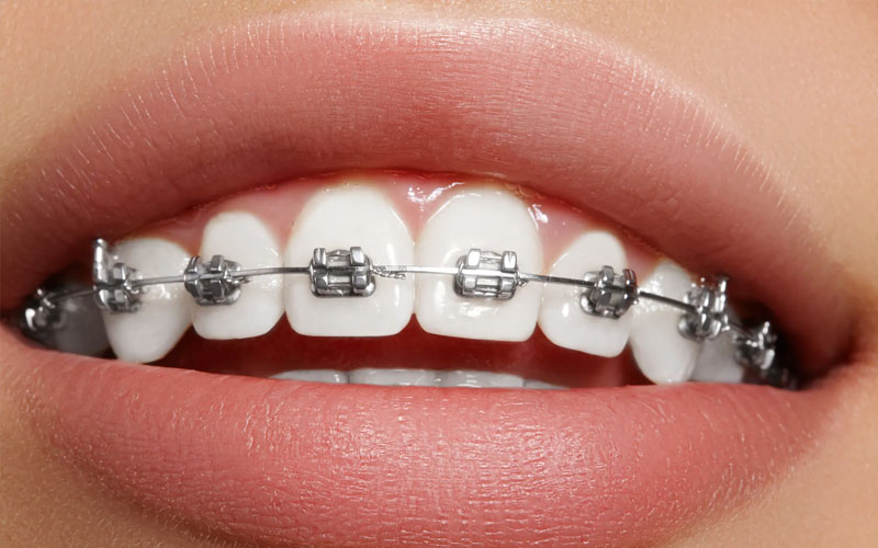 Chi phí niềng răng mắc cài phụ thuộc vào nhiều yếu tố liên quan