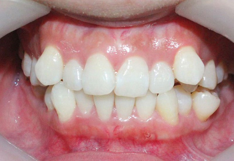 Niềng răng mắc cài kim loại tự buộc thích hợp với người có răng thưa, khấp khểnh