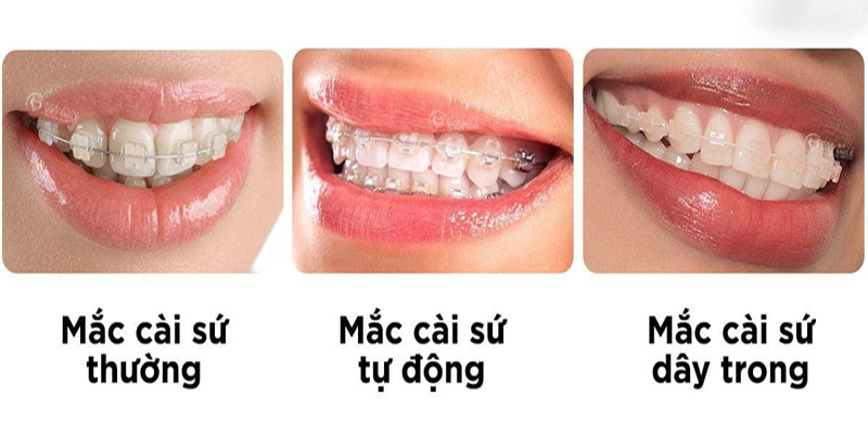 Có 3 loại niềng răng mắc cài sứ phổ biến hiện nay