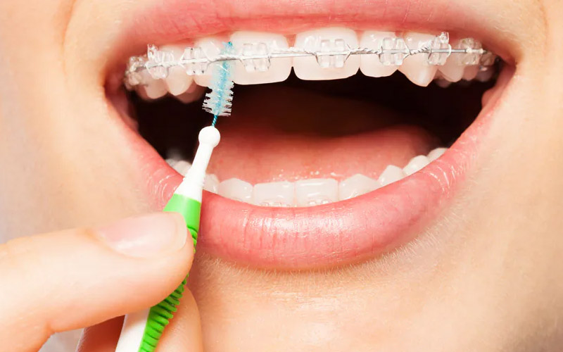 Làm sạch răng và mắc cài thật kỹ hàng ngày để tránh mắc bệnh nha khoa