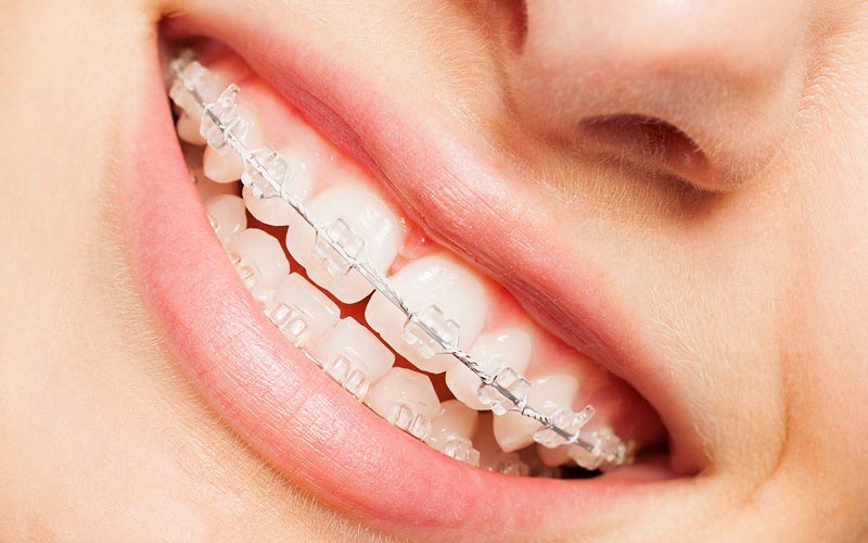 Thời gian niềng răng mắc cài trong suốt khoảng 18 - 24 tháng