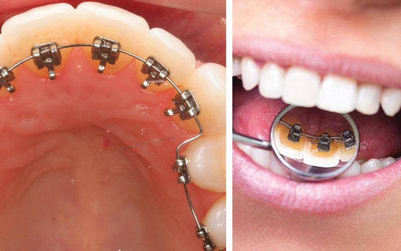Niềng răng mặt lưỡi gắn khí cụ ở mặt trong của răng