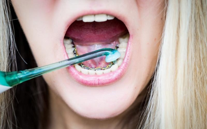 Hệ thống khí cụ ở mặt trong của răng gây khó khăn khi vệ sinh