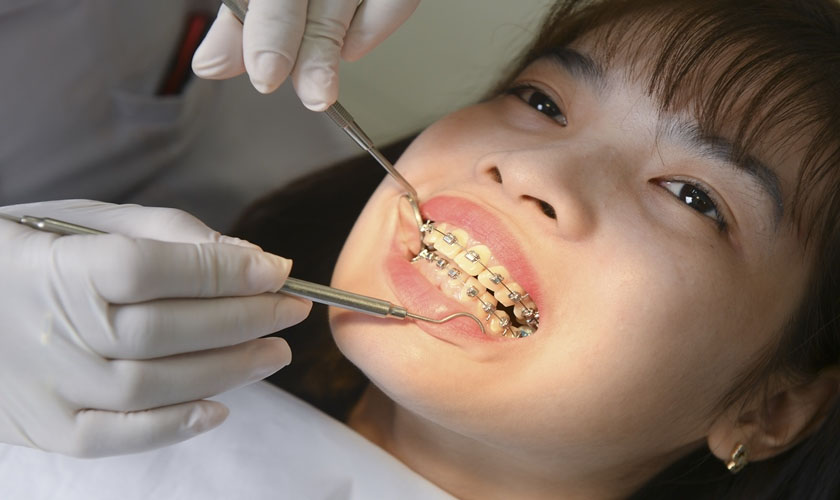 Quá trình niềng răng của từng phương pháp có sự khác biệt
