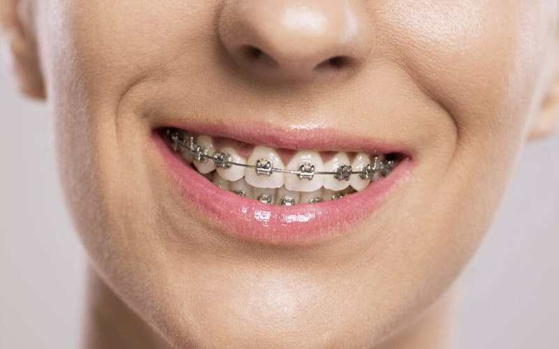 Niềng răng mắc cài kim loại đã xuất hiện từ khá lâu đời