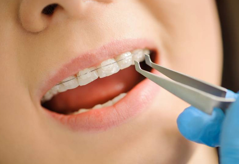 Quá trình gắn khí cụ lên răng có thể gây đau đớn