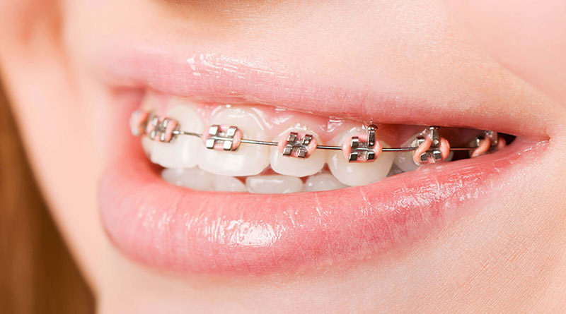 Giá niềng răng hô nhẹ phụ thuộc vào phương pháp niềng răng