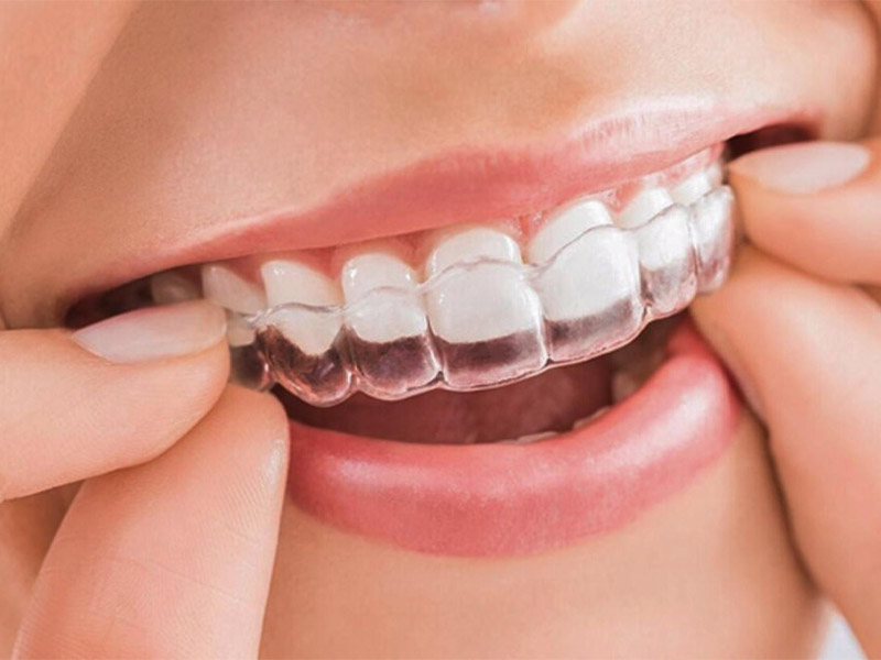 Niềng răng Invisalign là phương pháp chỉnh nha mới xuất hiện tại Việt Nam