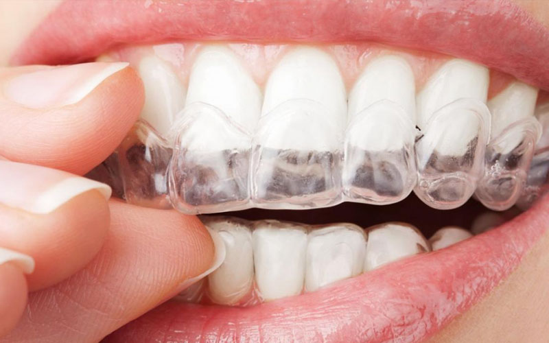 Thời gian niềng răng phụ thuộc vào mức độ lệch lạc của răng