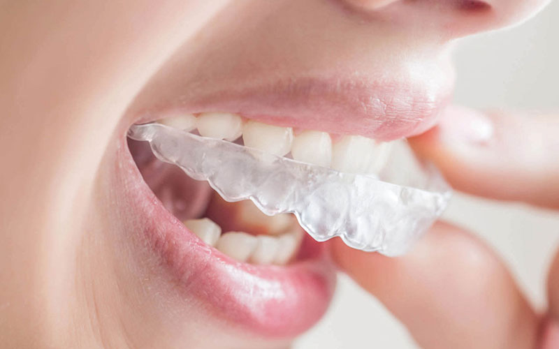 Niềng răng không mắc cài 3D Clear được nghiên cứu, phát triển tại Việt Nam