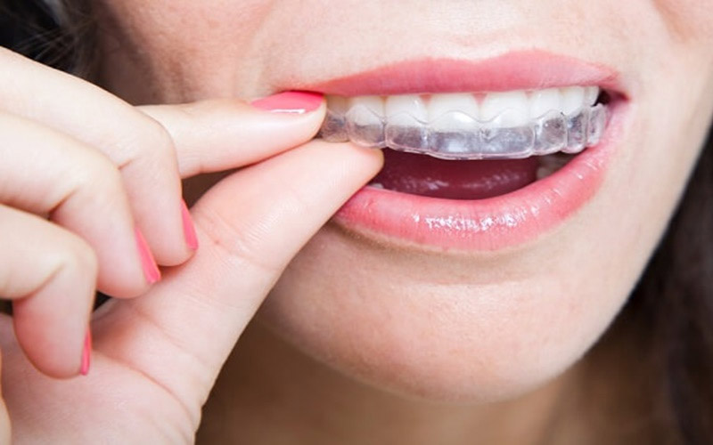 Niềng răng không mắc cài 3D Clear có thể gây khó chịu thời gian đầu