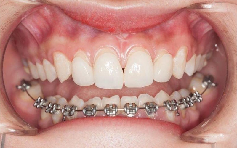 Niềng răng mắc cài kim loại cho răng móm có chi phí thấp