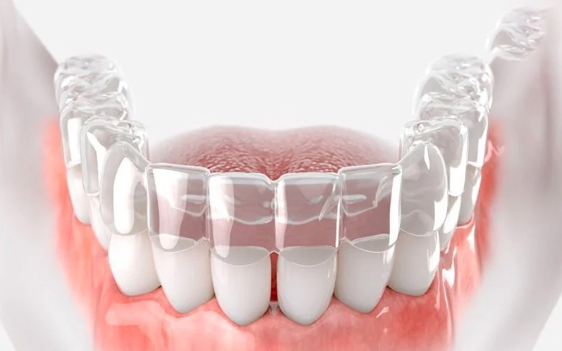 Niềng răng trong suốt có sự cải tiến từ phương pháp niềng răng mắc cài truyền thống