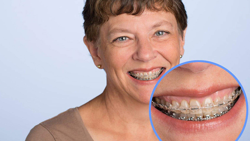 40 tuổi vẫn có thể niềng răng như bình thường