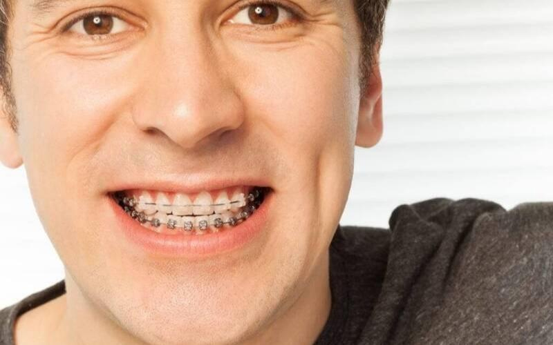 40 tuổi có thể niềng răng mắc cài để mang đến hiệu quả cao
