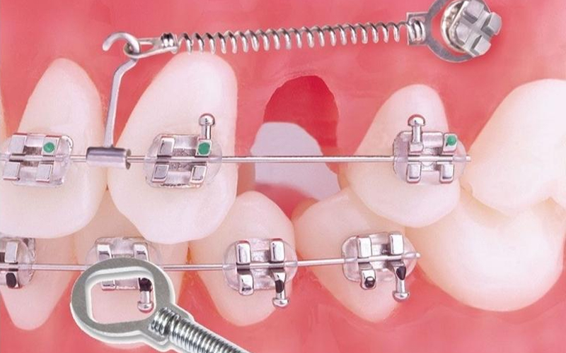 Có nhiều khí cụ được dùng để đóng khoảng trong niềng răng