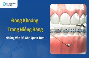 Đóng Khoảng Trong Niềng Răng Như Thế Nào, Mất Bao Lâu?