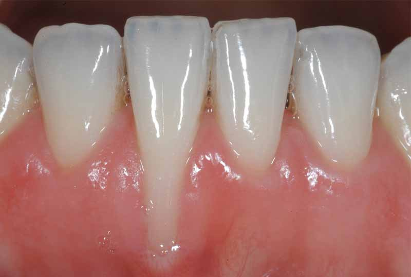 Niềng răng bị tụt lợi là hiện tượng khá phổ biến