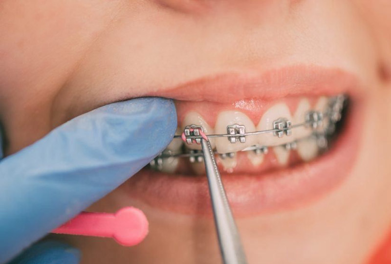 Niềng răng bị tụt lợi có thể do bác sĩ thực hiện sai kỹ thuật