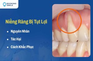 Niềng Răng Bị Tụt Lợi Do Đâu? Cách Khắc Phục Hiệu Quả Nhất